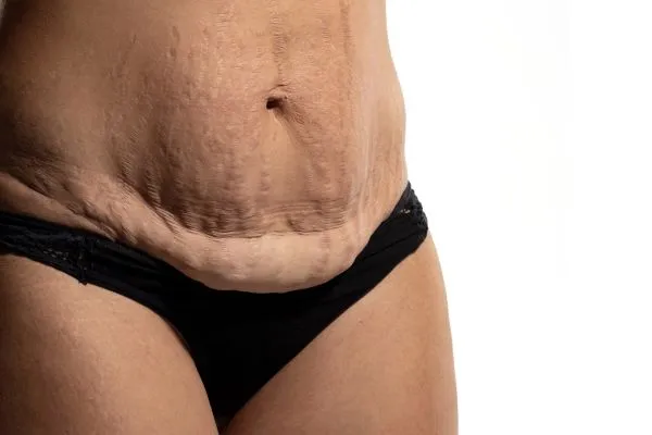 The science behind skin tightening Chester picture of a woman's sagging skin on the stomach